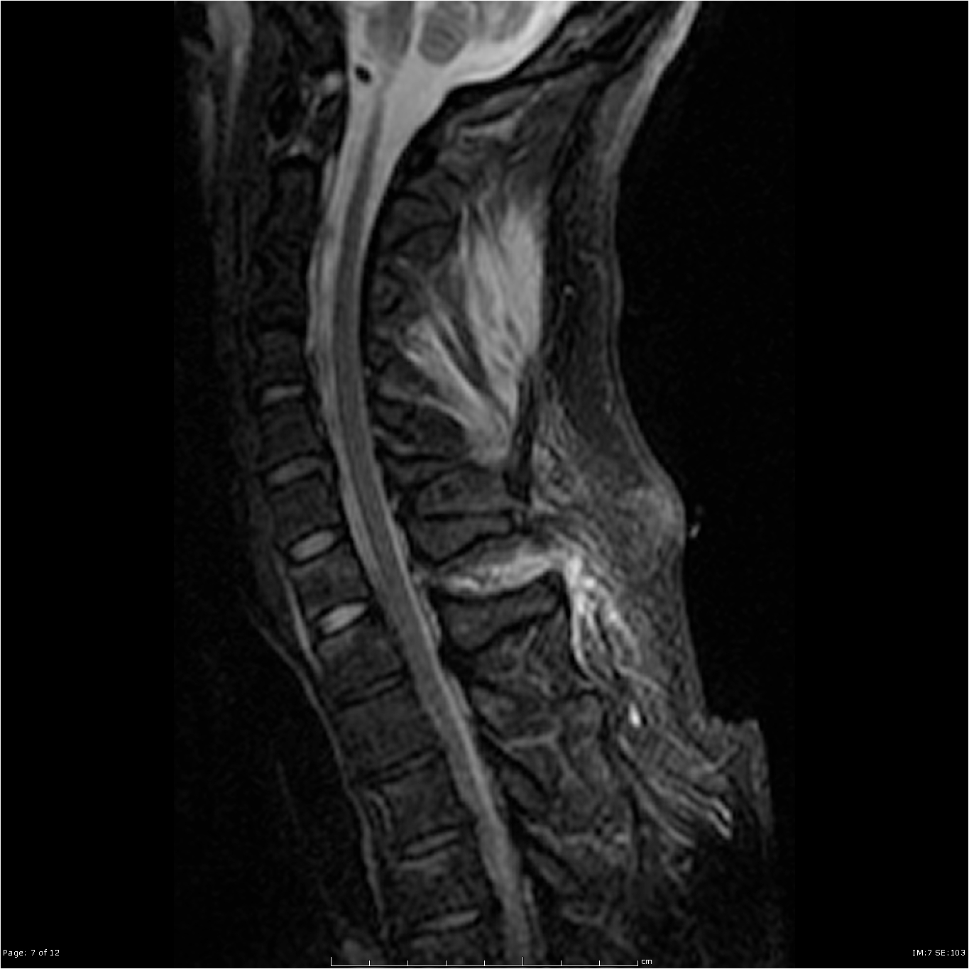 post-traumatic-ligamentum-flavum-tear.jpg