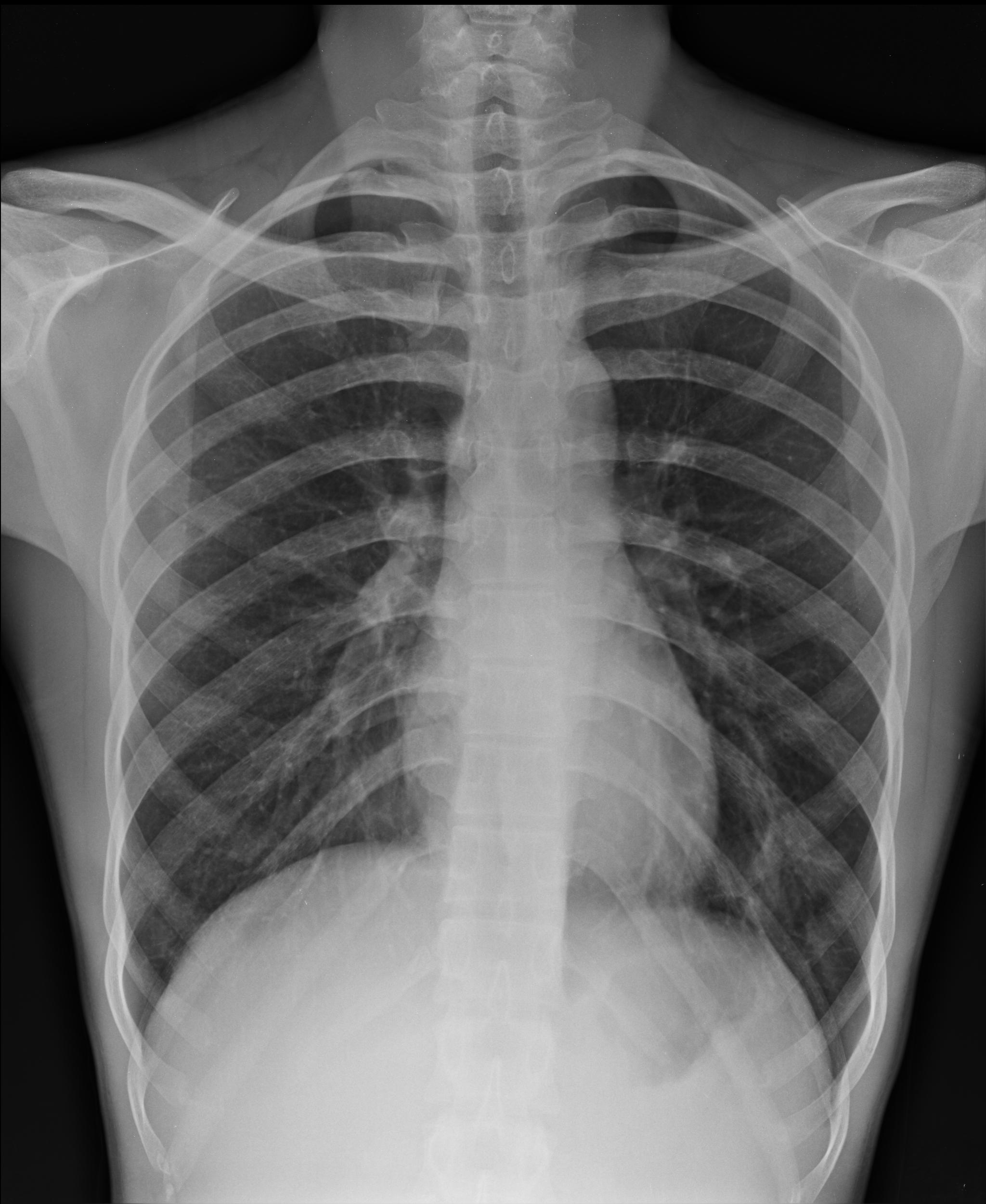 RibFractures-Figure1.jpg