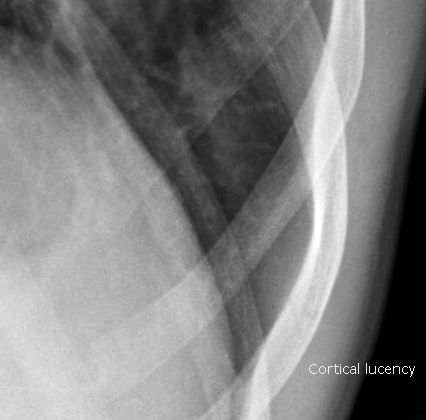 RibFractures-Figure2.jpg