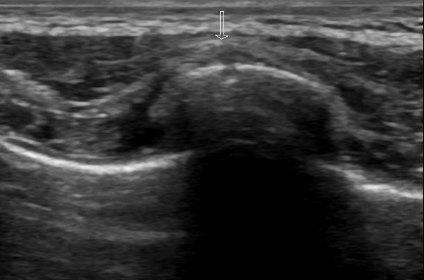 RibFractures-Figure4.jpg